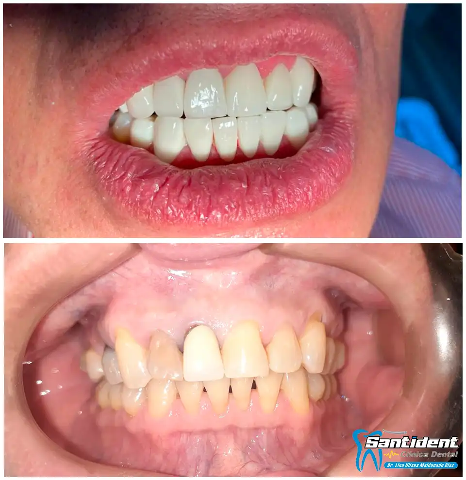 Antes y después de un tratamiento de carillas de zirconia