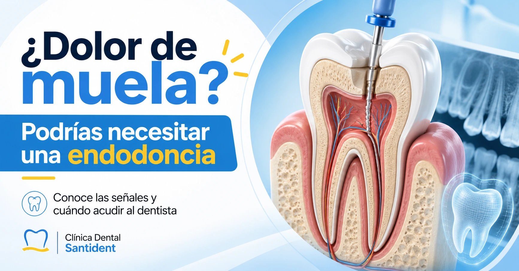 Endodoncia en Apatzingán: ¿cuándo se necesita y cómo ayuda a conservar tu diente?