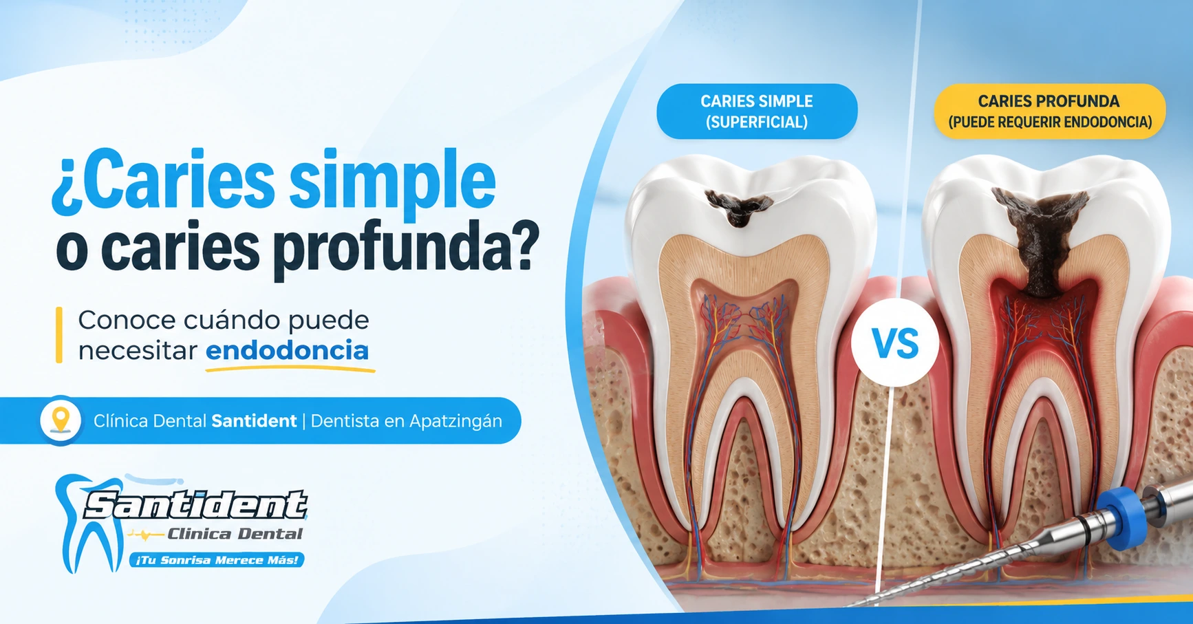 Caries simple vs caries profunda: ¿cuándo necesitas endodoncia en Apatzingán?