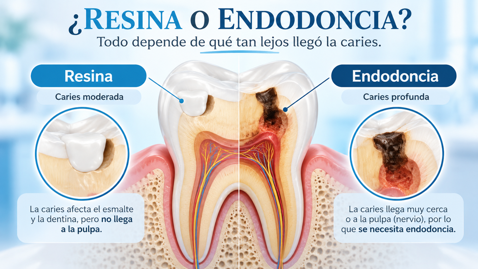 ¿Cuándo una caries se puede reparar con resina y cuándo necesita endodoncia?